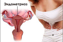 Бесплодие у женщин — что такое, симптомы, причины, лечение