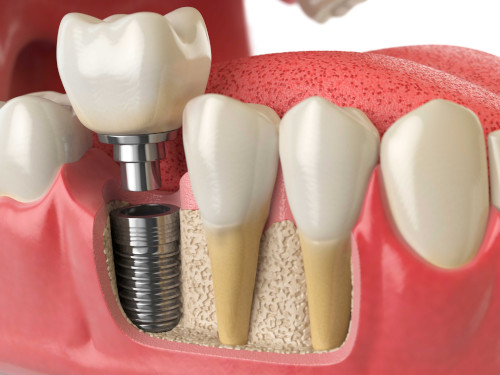 Benefits of dental implantation