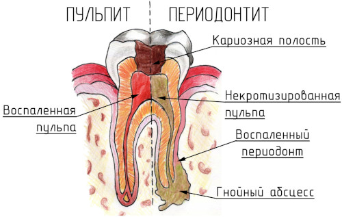 Причины появления кисты зуба