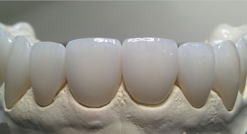 Types of ceramic crowns