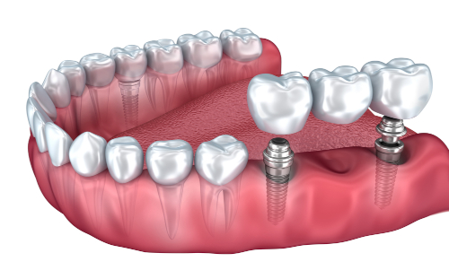 Features of bridges on implants