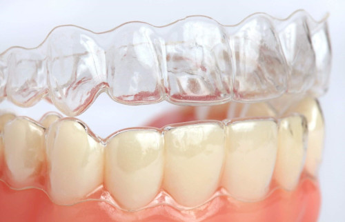 The mechanism of operation of aligners in the process of correcting a bite