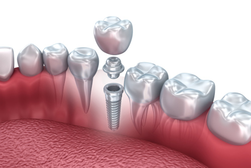 What to consider when choosing implants