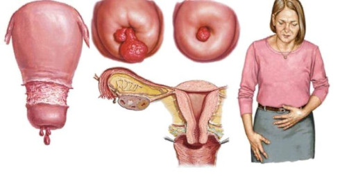 Полип цервикального канала (полип шейки матки) - симптомы и лечение