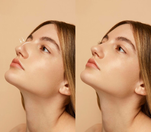 Septoplasty and Rhinoplasty – What’s the Difference?