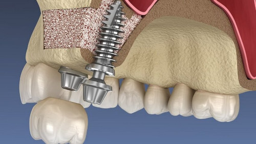 Open and closed sinus lift