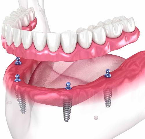 Indications and contraindications for fixed prosthetics