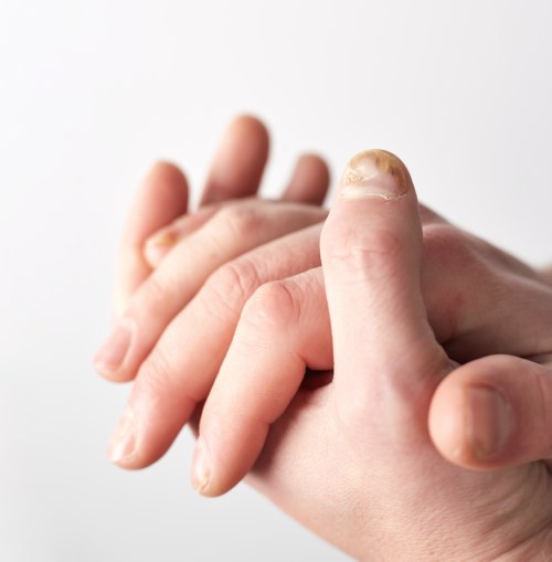 Fungal infection on nails