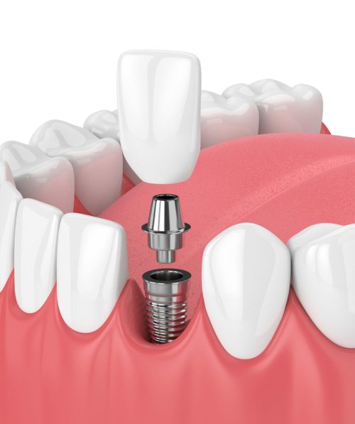 Single-stage dental implantation: what is it?