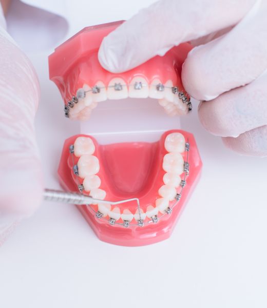 The mechanism of teeth straightening with braces