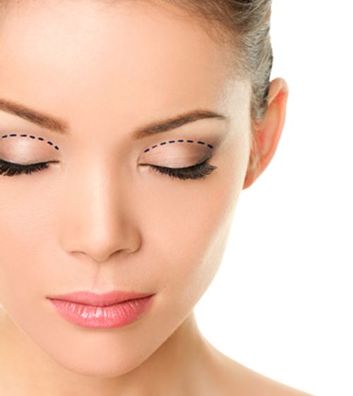 Types of eyelid surgery