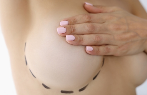 Breast asymmetry