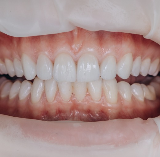 Types of ceramic veneers