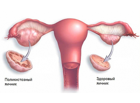 Cиндром поликистозных яичников (СПЯ)