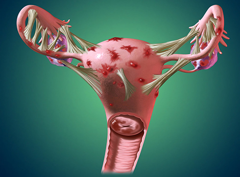 Diagnosis and treatment of endometriosis